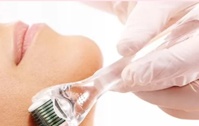 microneedling almere